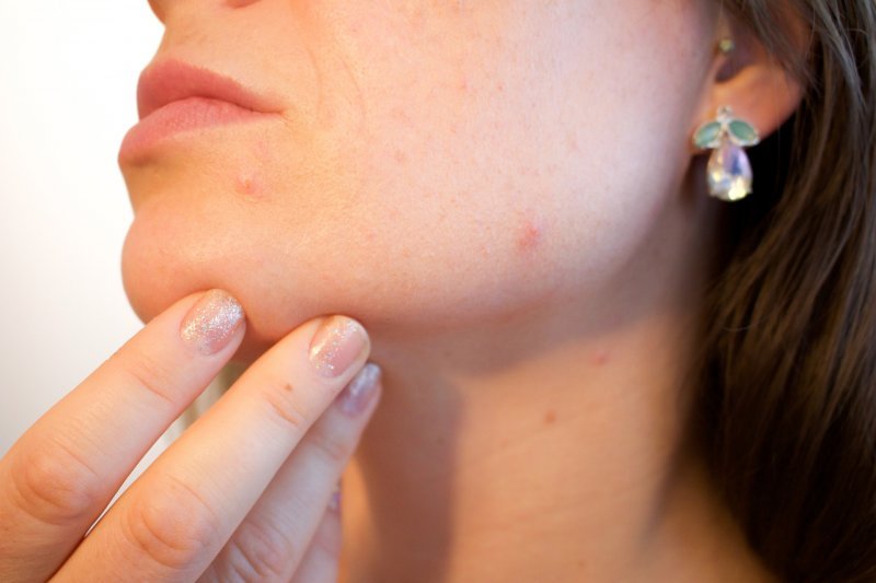 TRAITEMENT D'ACNE PAR LASER